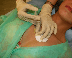 Aféierung vu Meso-Cocktail an Broschtgewebe - eng Alternativ zu Hyaluronsäure-Injektiounen