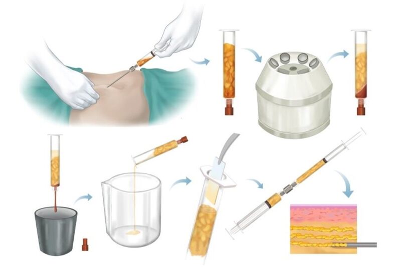 Entfernung vu Fett aus Problemgebidder, Veraarbechtung an Injektioun an Brustgewebe