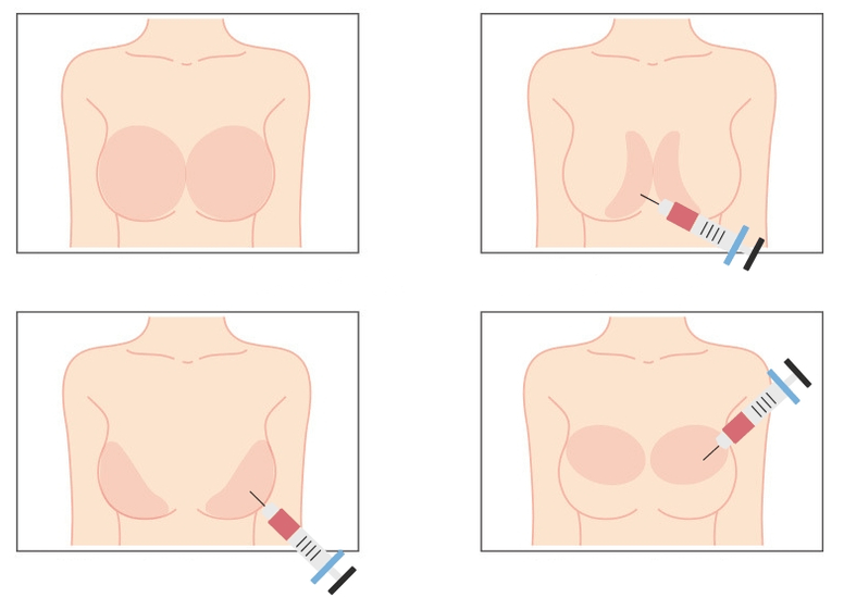 Plazen fir d'Injektioun vun Hyaluronsäure an d'Brust