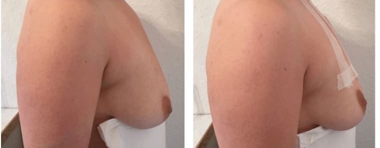 Virun an nom Fuedem Brustlift