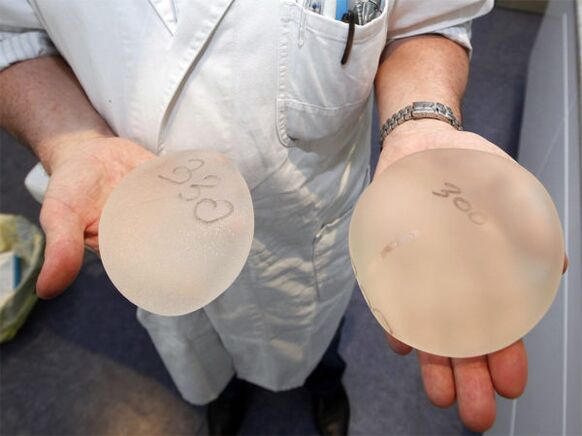 Broscht Implantate fir Büste Erweiderung