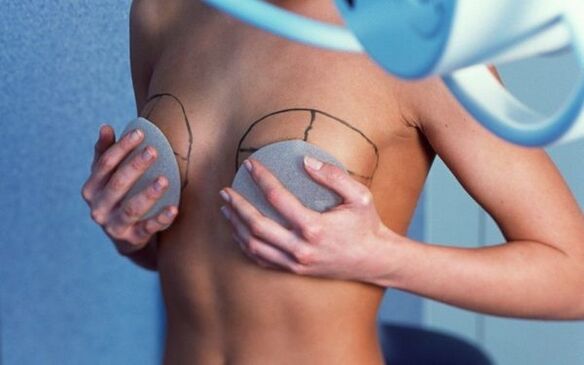 Brustvergréisserung mat Implantate