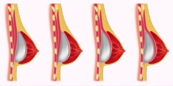 Methode fir d'Installatioun vun Implantate fir d'Brustvergréisserung