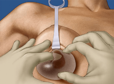 Submammary Insertion vum Implantat an d'Brust